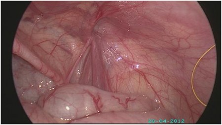 Gambar 1 : kawasan berbuih menunjukkan selaput processus vaginalis yang gagal tertutup.