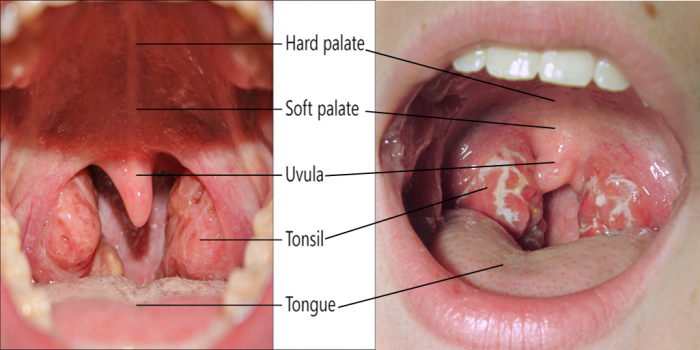 Gambar 1: Tonsil yang bengkak dan radang (http://tonsillectomyrecovery.com/tonsillitis-pictures/) Gambar 2: Tonsil yang bengkak, radang dan bernanah (http://en.wikipedia.org/wiki/Wikipedia:WikiProject_Medicine/Translation_task_force/Strep_throat_bn)