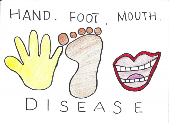 hand-foot-mouth-disease