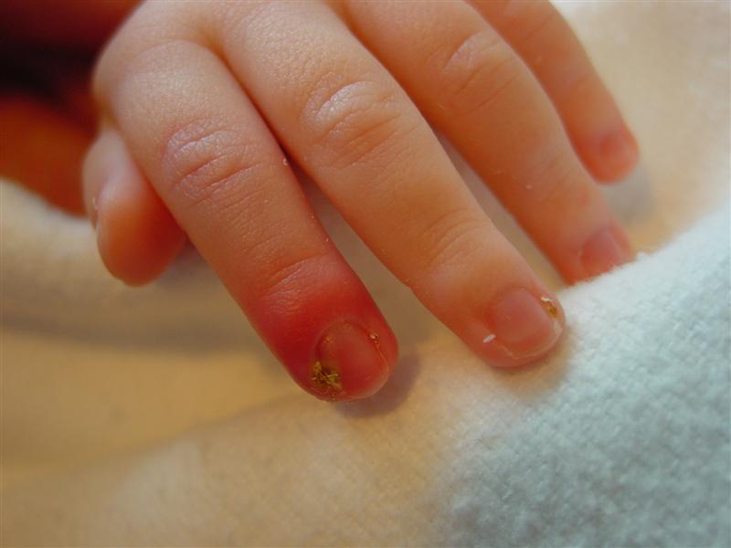 Clinical Quiz: A nail infection :: C+D